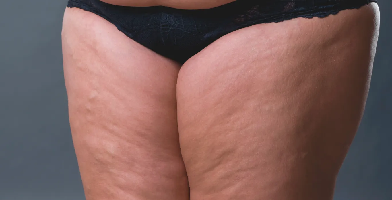 Lipödem erkennen und behandeln: Was Sie über Therapiemöglichkeiten wissen sollten